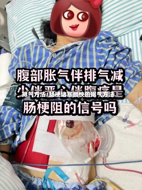 排气方法/肠梗堵塞最快的排气方法-第1张图片
